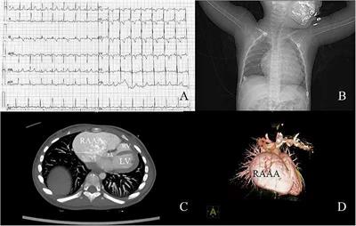 Case Report: A giant right atrial appendage aneurysm in a child